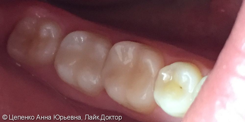 Дефект пломб зубов 4.6,4.7 - фото №5