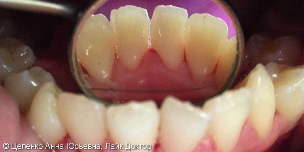 Профессиональная чистка всех групп зубов - фото №6