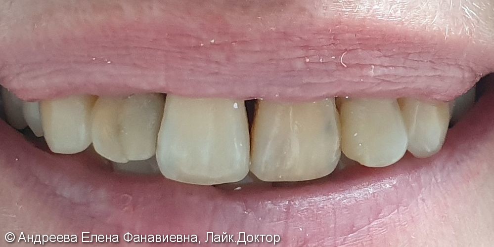 Лечение центральных зубов - фото №1