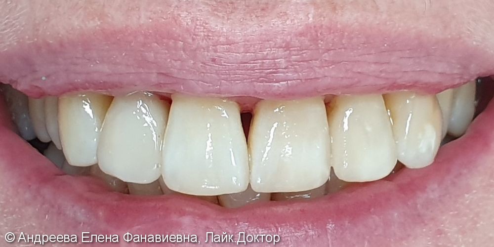 Лечение центральных зубов - фото №2