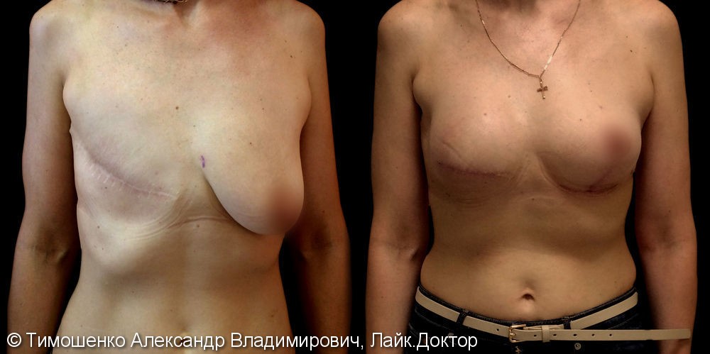 Новая грудь: как восстанавливают красоту молочной железы после мастэктомии