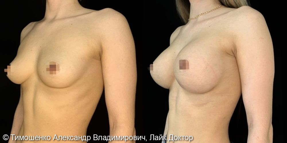 Увеличение груди - после