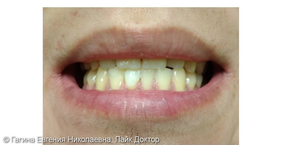 Восстановление зуба после травмы - фото №1