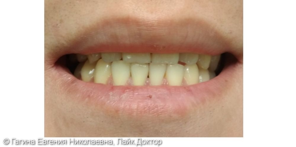 Восстановление зуба после травмы - фото №2