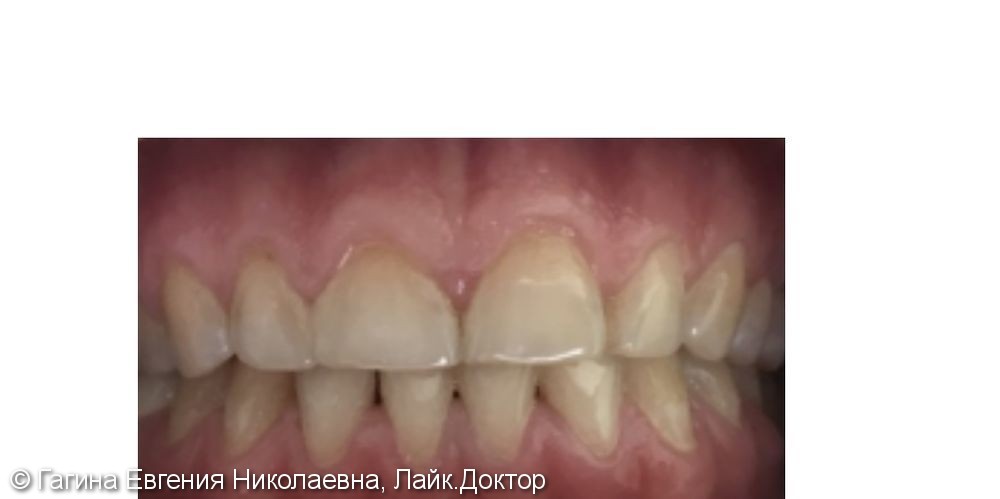 Керамические реставрации фронтальных зубов - фото №1