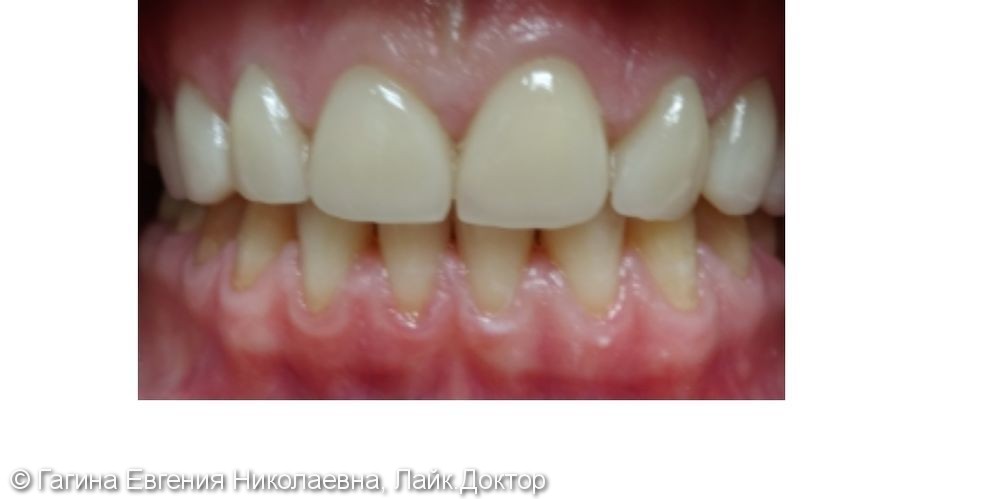 Керамические реставрации фронтальных зубов - фото №2