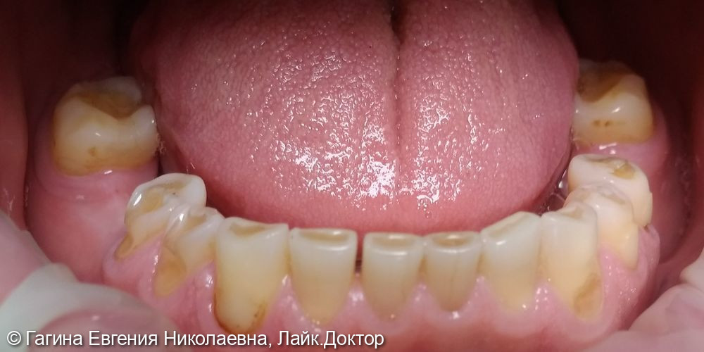 Лечение патологической стираемости зубов - фото №2