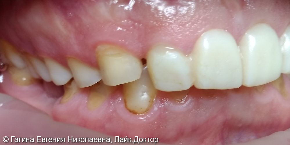 Лечение патологической стираемости зубов - фото №3