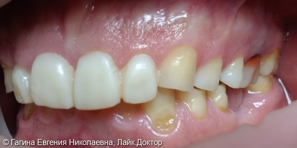 Лечение патологической стираемости зубов - фото №4
