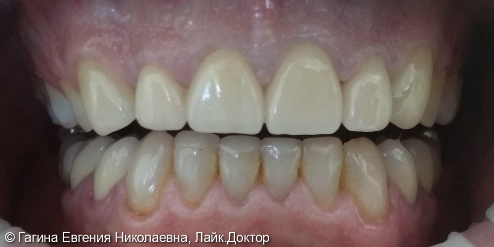 Лечение патологической стираемости зубов - фото №5