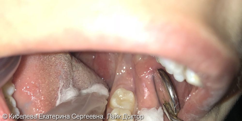 Лечение кариеса 37 зуба - кариес дентина у ребенка - фото №1