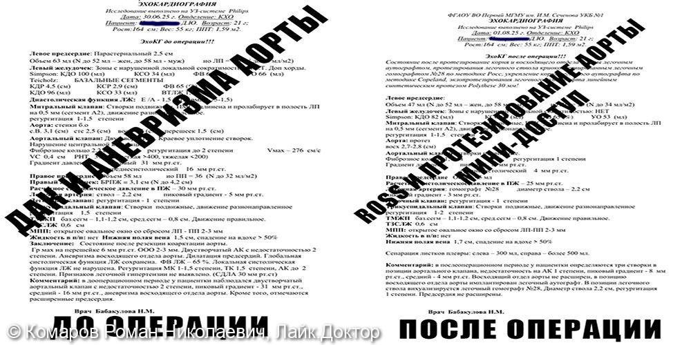 Росс-операция и протезирование восходящей аорты через мини-доступ у 21-летней пациентки - фото №1
