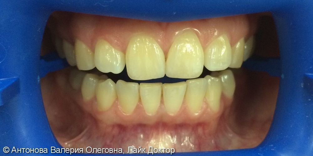 Чистка + отбеливание зубов системой ZOOM4, до и после - фото №1