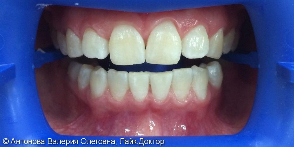 Чистка + отбеливание зубов системой ZOOM4, до и после - фото №2