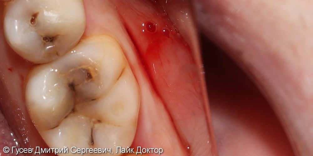 Лечение кариеса, прямая реставрация зубов 3.5, 3.6 - фото №1