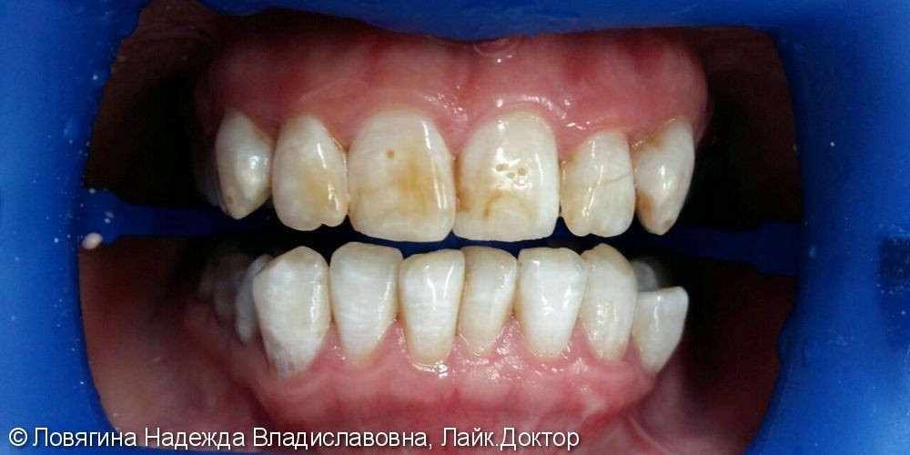 Результат отбеливания зубов аппаратом Zoom 4 - фото №1