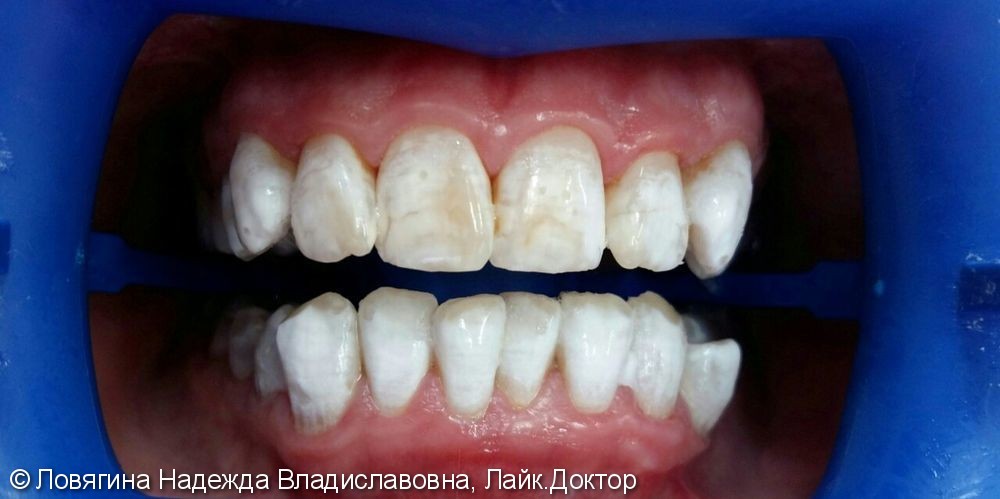 Результат отбеливания зубов аппаратом Zoom 4 - фото №2