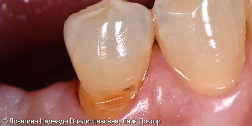 Лечение пришеечного поражения зуба - фото №1