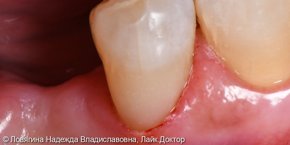Лечение пришеечного поражения зуба - фото №2