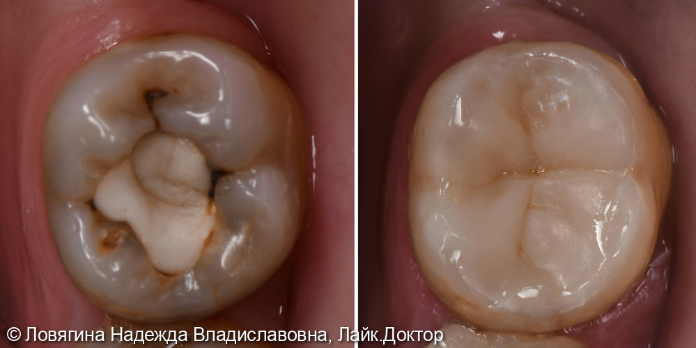 Лечение кариеса и реставрация зуба 3.7 - фото №1