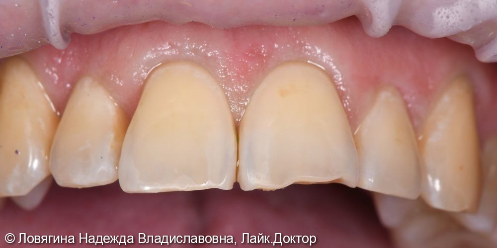 Микроабразия эмали зубов - фото №2