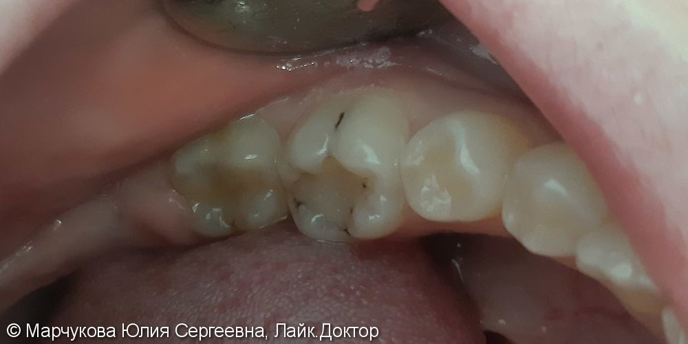 Лечение глубокого кариеса 3.6 зуба - фото №1