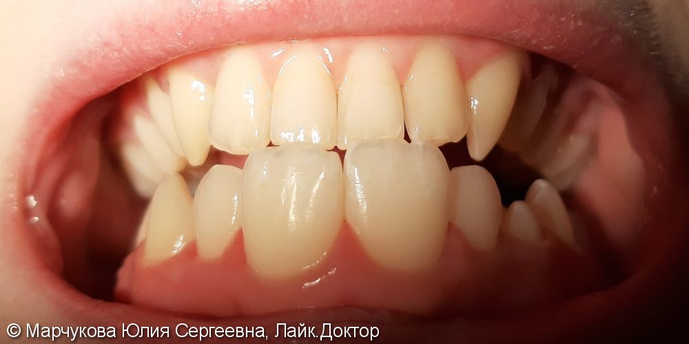Профессиональная гигиена зубов - фото №2
