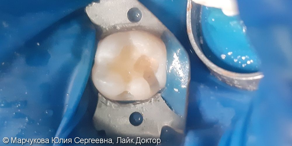 Лечение глубокого кариеса 4.6 зуба - фото №4