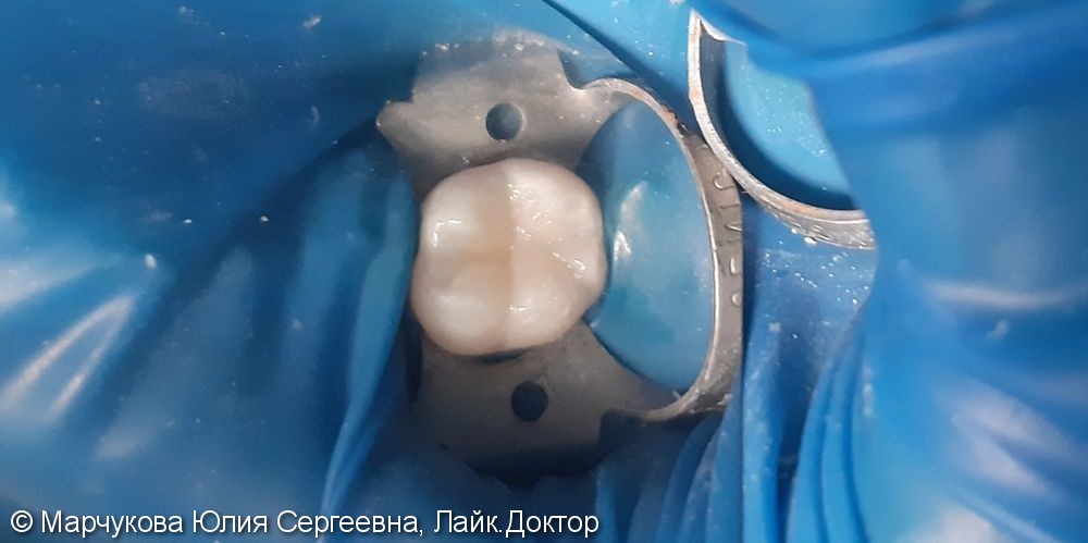 Лечение глубокого кариеса 4.6 зуба - фото №5