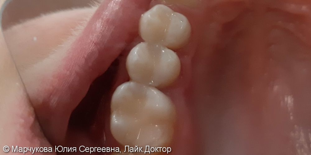 Лечение кариеса 1.5, 1.4 зубов - фото №4