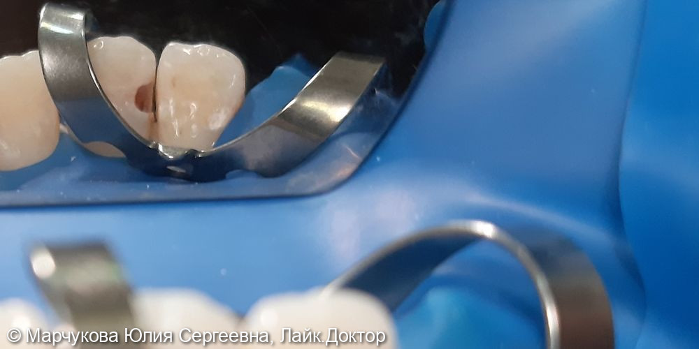 Лечение глубокого кариеса 1.1 зуба - фото №1