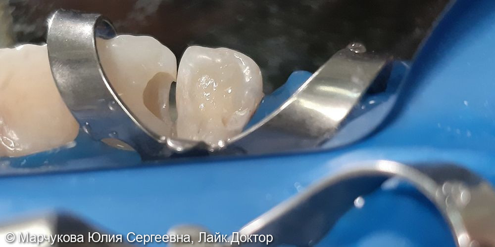 Лечение глубокого кариеса 1.1 зуба - фото №2