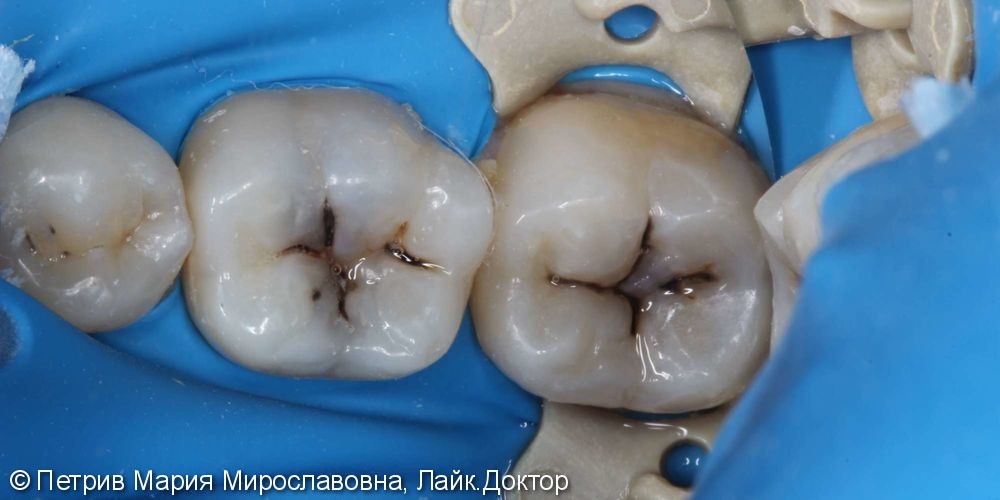 Жалобы на потемнение зубов 3.6, 3.7, кратковременные боли на сладкое - фото №1