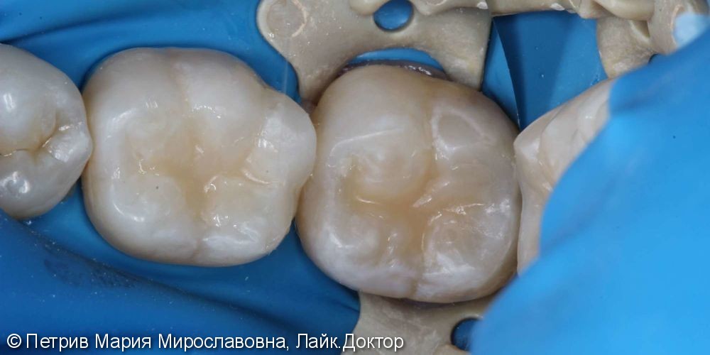 Жалобы на потемнение зубов 3.6, 3.7, кратковременные боли на сладкое - фото №2