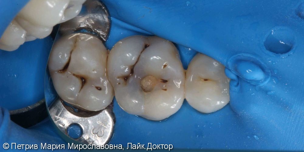 Лечение кариеса зубов 1.6, 1.7, до и после - фото №1