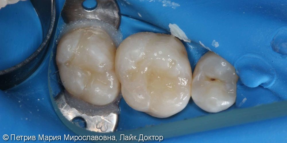 Лечение кариеса зубов 1.6, 1.7, до и после - фото №4