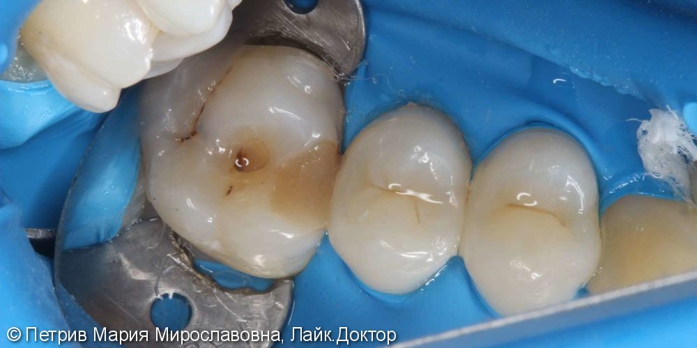 Скрытые кариозные полости 1.6, 1.5 зубов, до и после лечения - фото №1