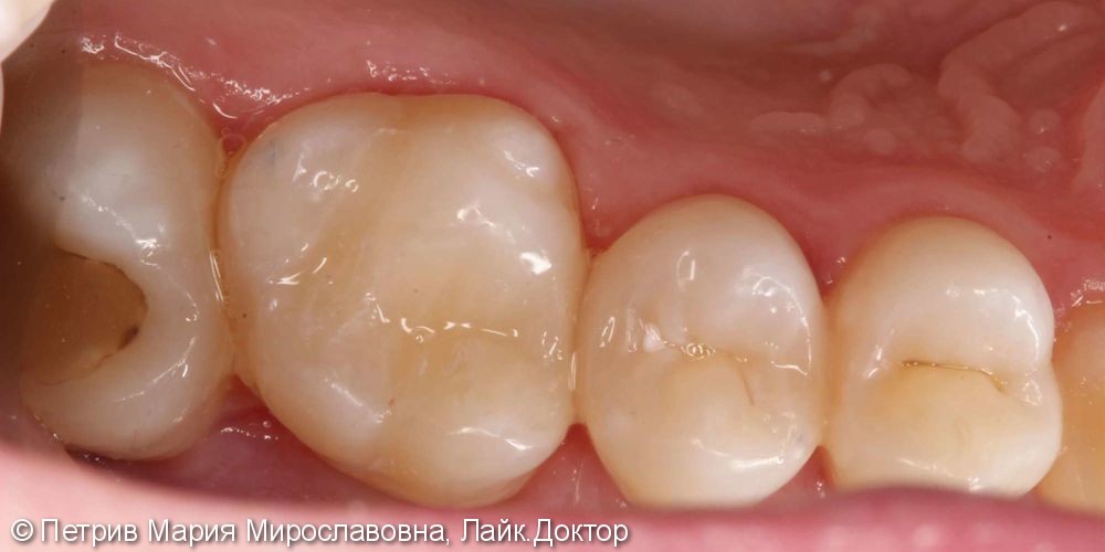 Скрытые кариозные полости 1.6, 1.5 зубов, до и после лечения - фото №3