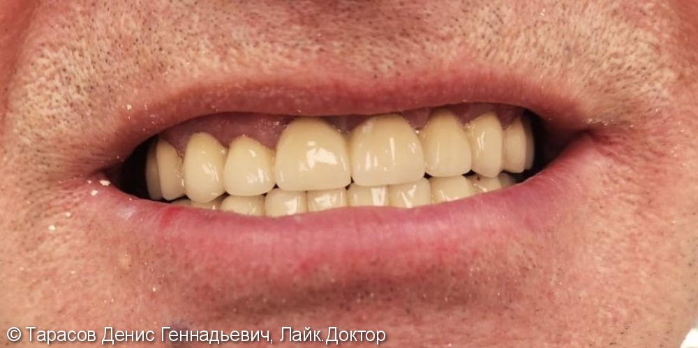 Ортопедическое лечение при повышенной стираемости зубов - фото №2