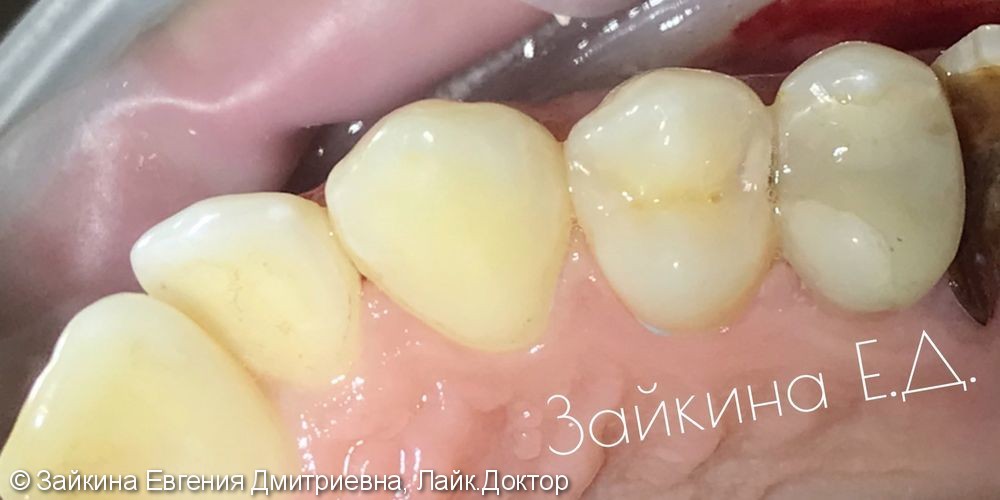 Лечение среднего кариеса зубов 1.5, 1.6 - фото №1