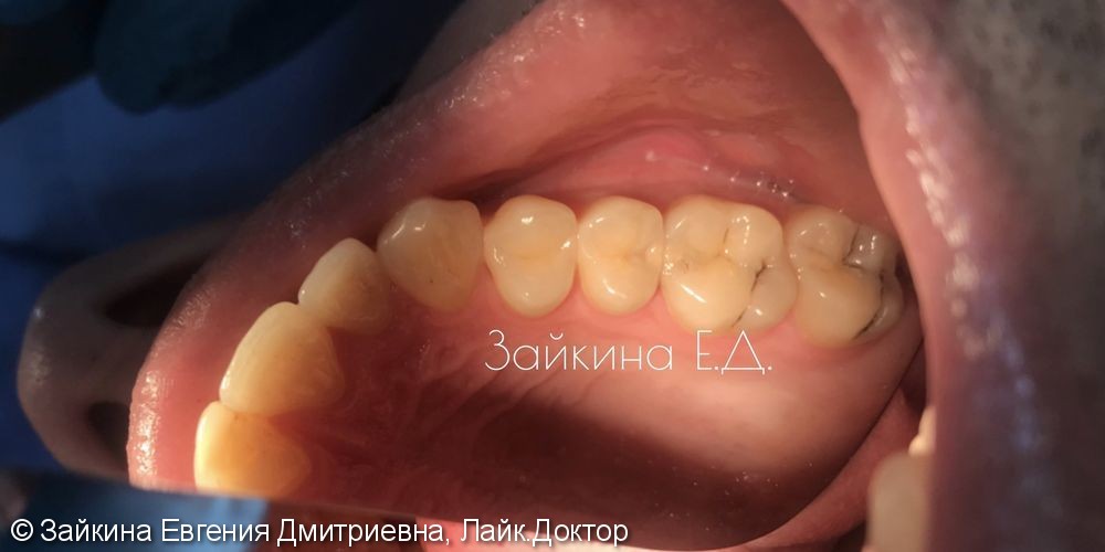 Лечение среднего хронического кариеса зубов 1.5, 1.6 - фото №1