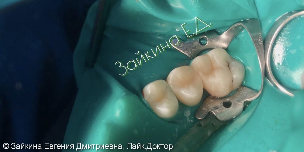 Лечение среднего хронического кариеса зубов 1.5, 1.6 - фото №4