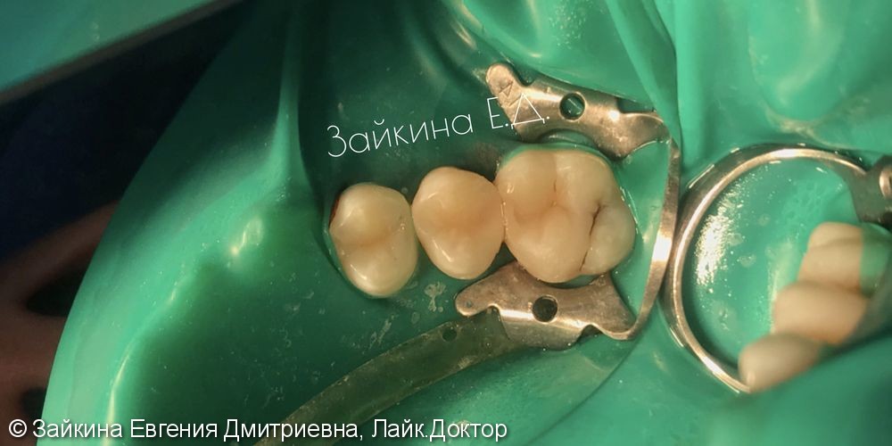 Лечение среднего хронического кариеса зубов 1.5, 1.6 - фото №5