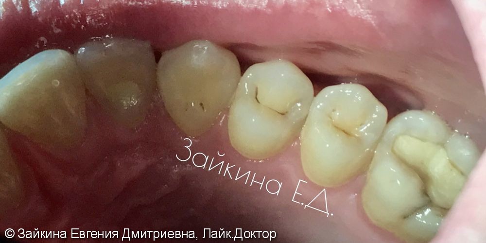 Лечение хронического среднего кариеса зуба 1.4 - фото №1