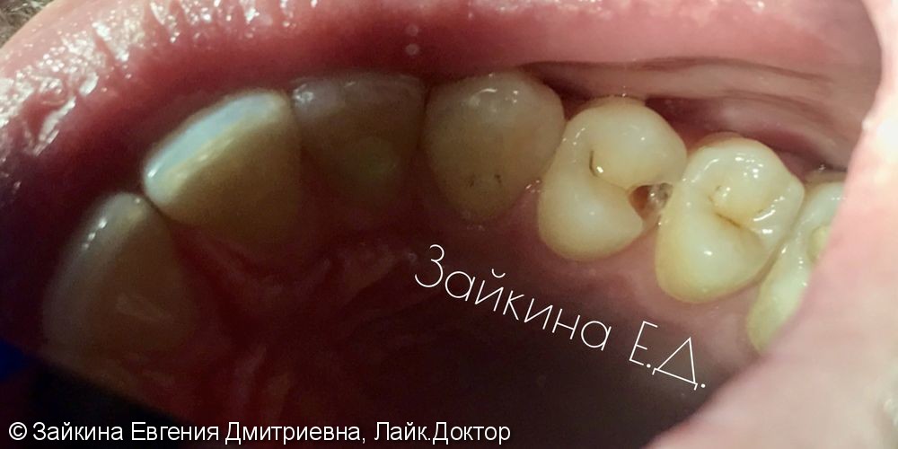 Лечение хронического среднего кариеса зуба 1.4 - фото №2