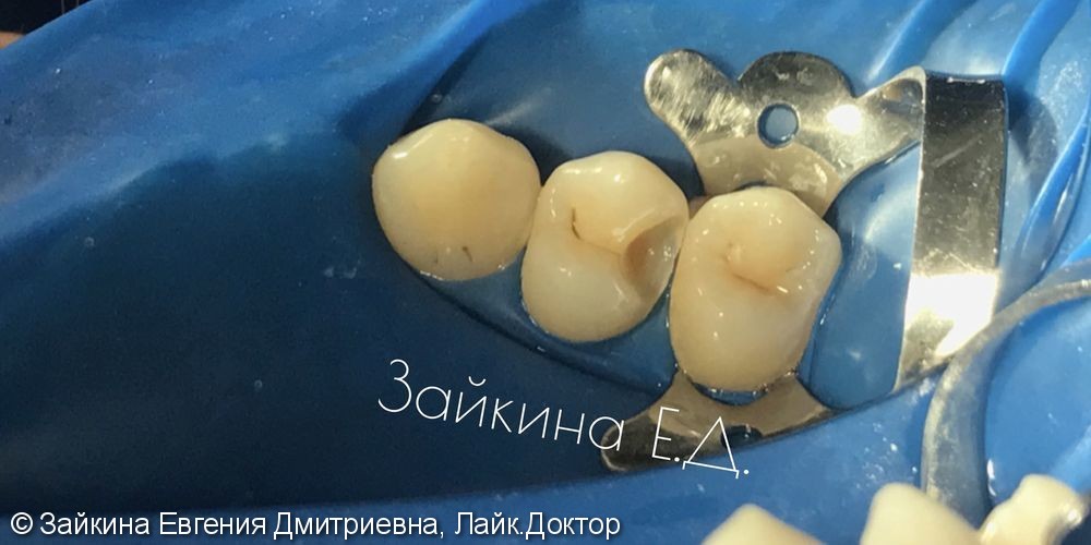 Лечение хронического среднего кариеса зуба 1.4 - фото №3