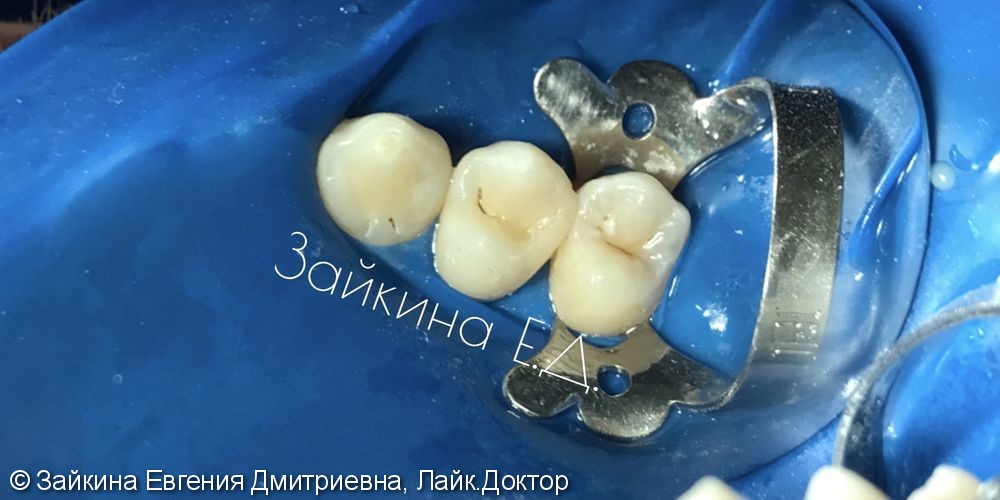 Лечение хронического среднего кариеса зуба 1.4 - фото №4