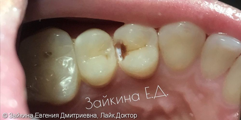 Проведено лечение среднего кариеса зуба 1.4 - фото №1