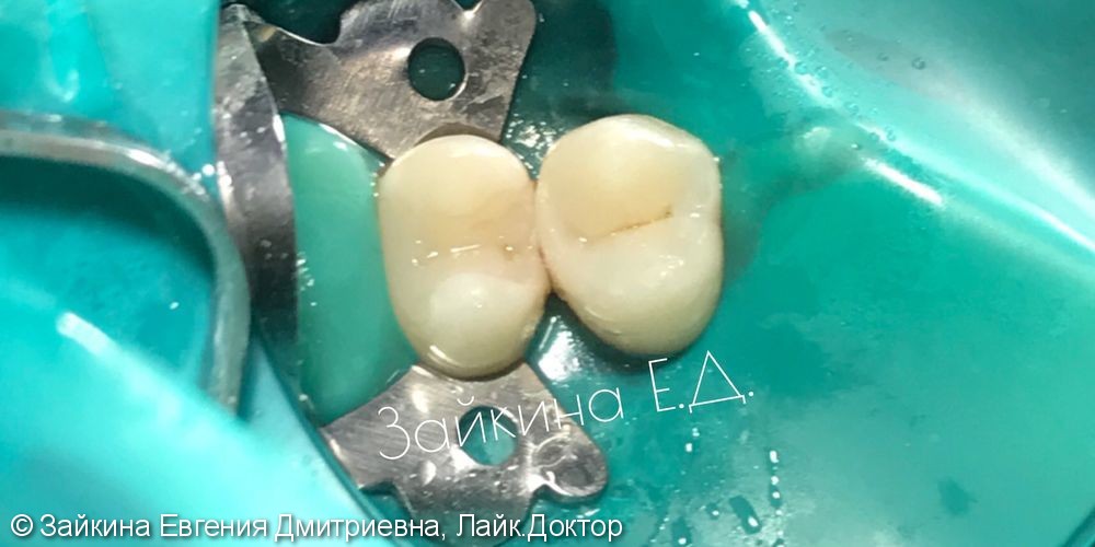 Проведено лечение среднего кариеса зуба 1.4 - фото №4