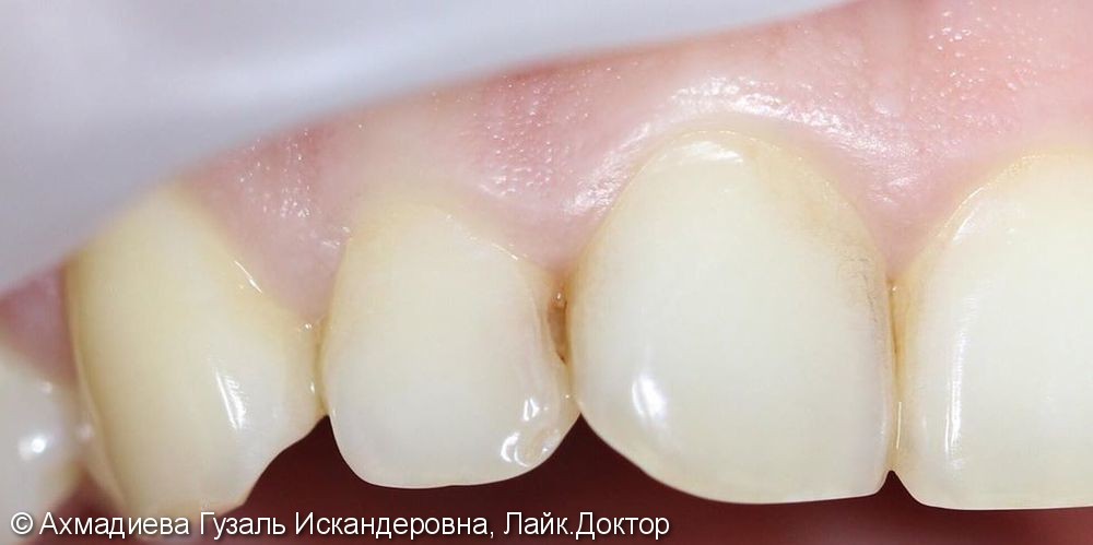 Лечение среднего кариеса 11, 12 зубов, реставрация - фото №1